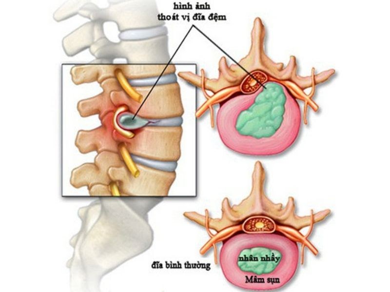 Thoát vị đĩa đệm cũng một trong các nguyên nhân gây đau ở đốt sống lưng